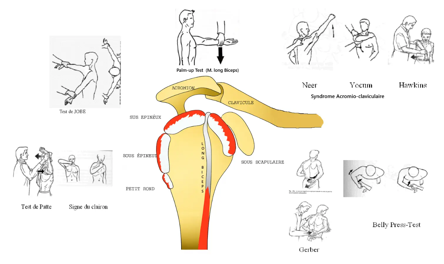 Illustration 1 — Tendinopathie de la coiffe