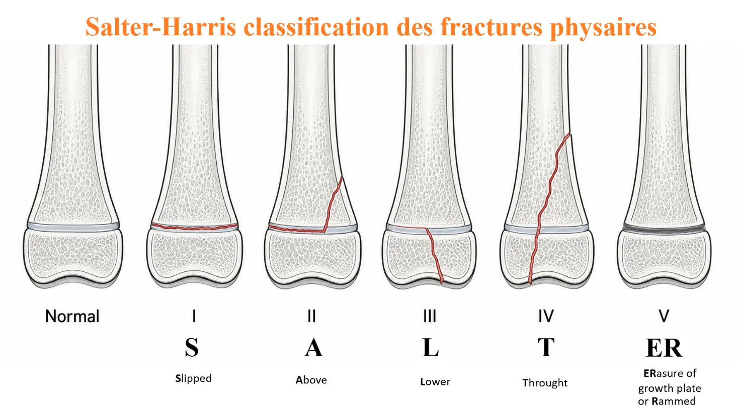 Classification de Salter-Harris des fractures physaires : types I à V et moyen mnémotechnique SALTER